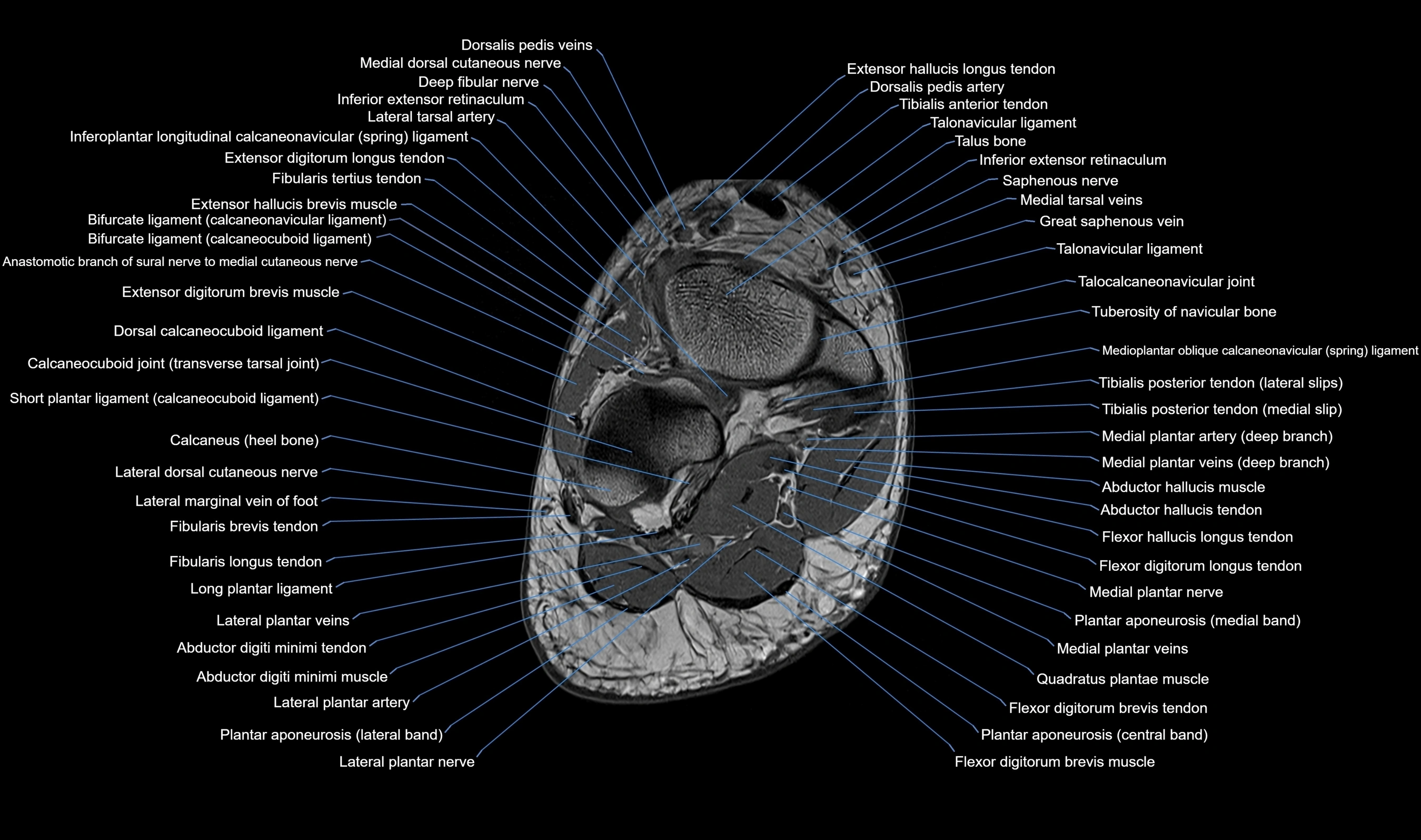 MRI mid foot axial cross sectional anatomy 3T  radiology  image-img-00001-00035.webp